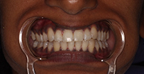 6-8months Invisalign After