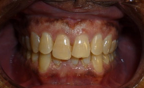 Teeth Whitening 3 Before