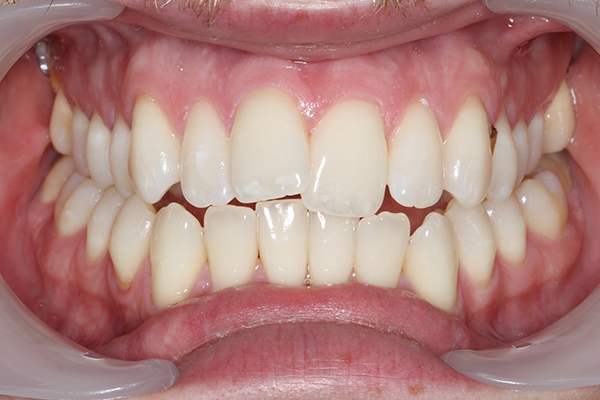 Post Teeth Whitening Treatment in Milton Keynes