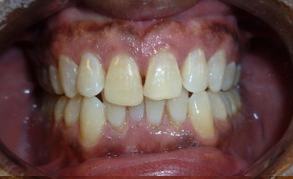 Teeth Whitening 3 After