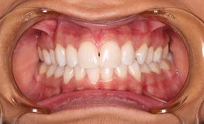 Teeth Whitening 4 After