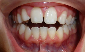 Teeth Whitening 2 After