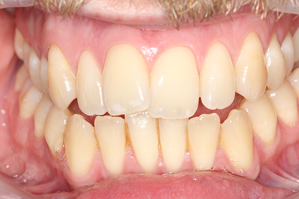 Pre Teeth Whitening Treatment in Milton Keynes