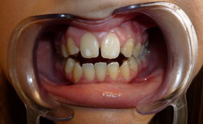 Teeth Whitening 2 Before