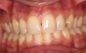 Teeth Whitening 4 Before