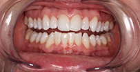 Teeth Whitening 5 After