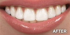 Teeth Whitening After
