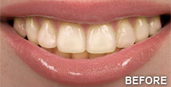 Teeth Whitening Before