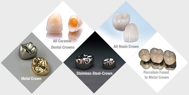 Types of Crowns