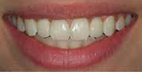 After Dental Implants near me in Milton Keynes