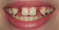 Before Dental Implants near me in Milton Keynes