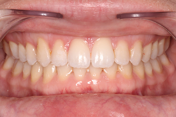 Invisalign Milton Keynes Buckinghamshire 5 Invisible Braces