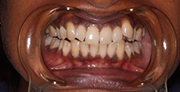 6-8months Invisalign Before