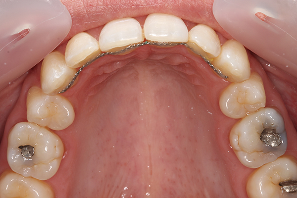 8 months Invisalign After