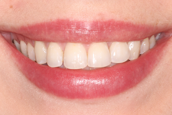 After Invisalign treatment in Milton Keynes