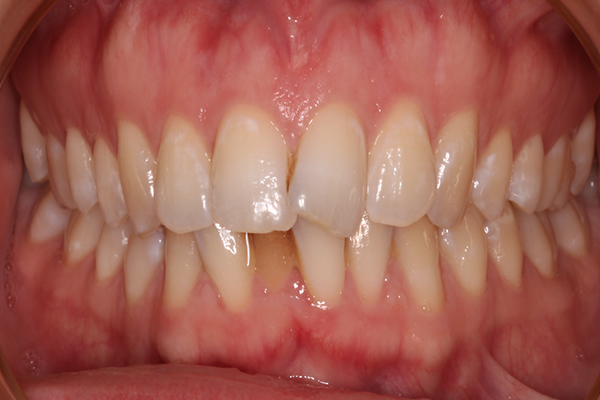 Before Invisalign treatment in Milton Keynes