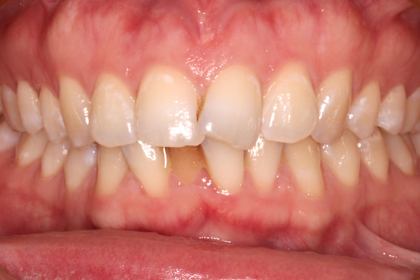 Before Invisalign treatment in Milton Keynes