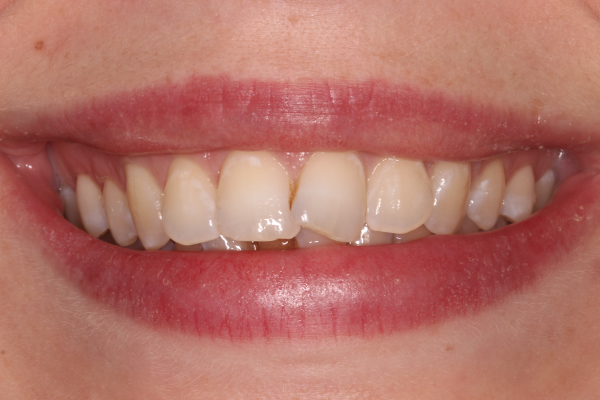 Before Invisalign treatment in Milton Keynes