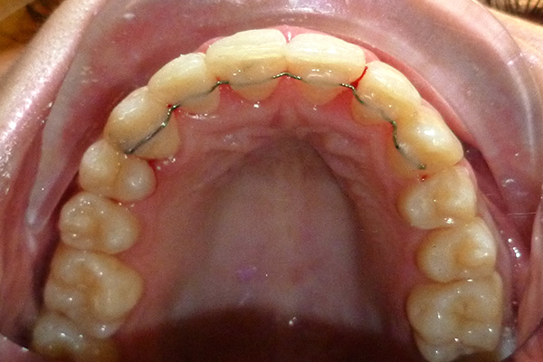 After Six Month Smile Treatment in Milton Keynes