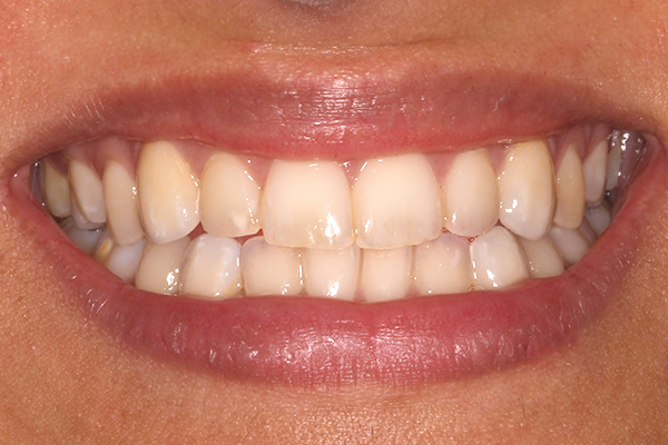 After Dental Veneers in Milton Keynes