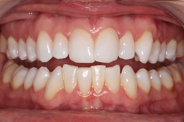 After Whitening Treatment in Milton Keynes