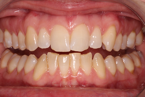 Before Whitening Treatment in Milton Keynes