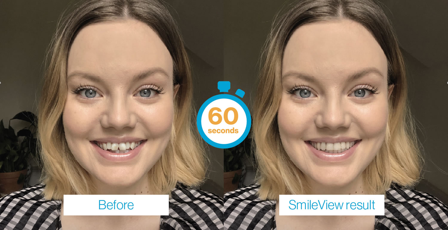 Invisalign SmileView