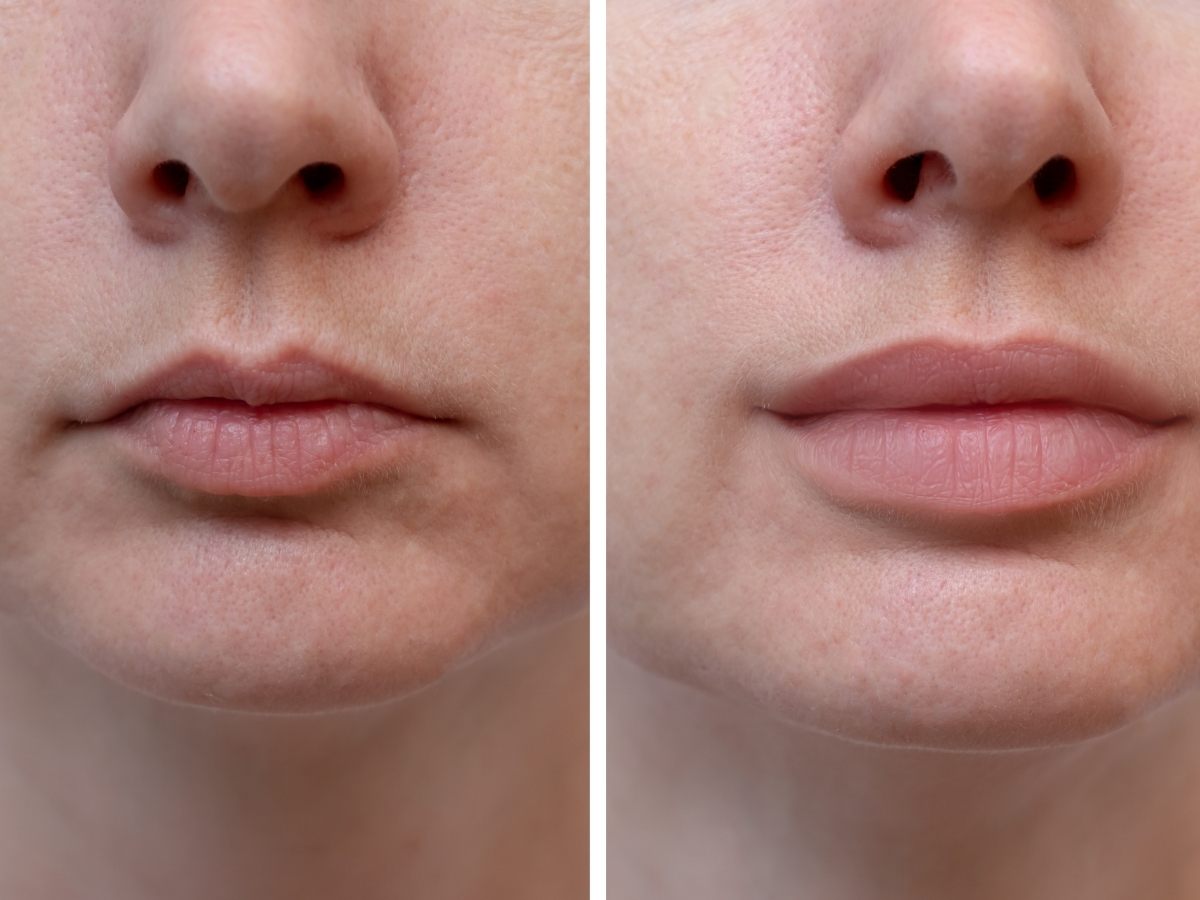 before and after lip fillers milton keynes